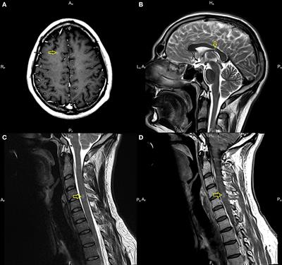 Case report: First manifestation of multiple sclerosis temporally correlated with COVID-19 vaccination